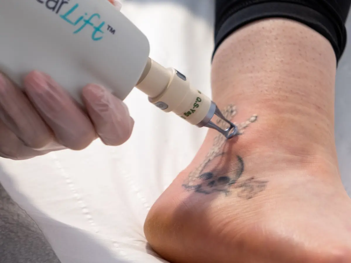 Laser Tattoo Removal Technology: Types of Lasers Used Today